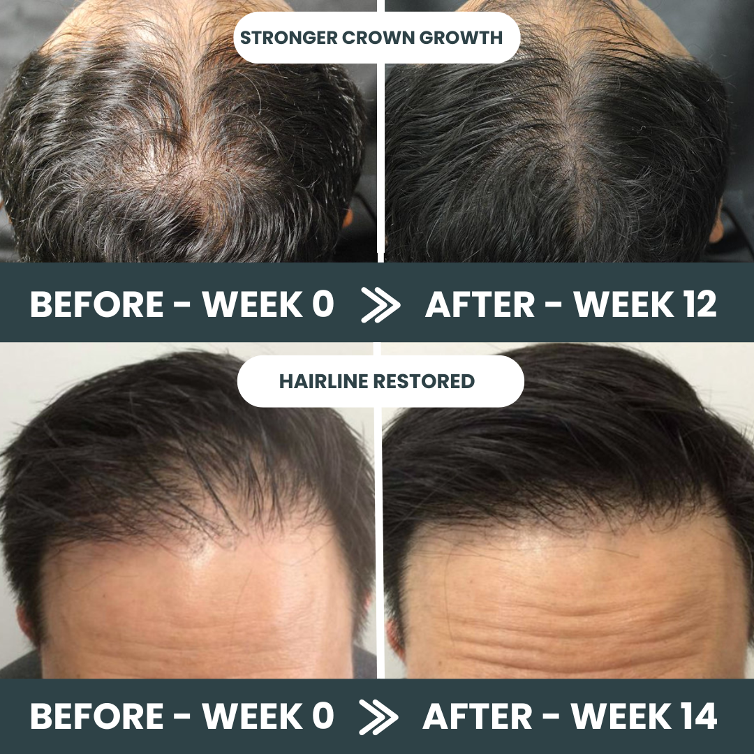 Stark One™ Regrowth Kit